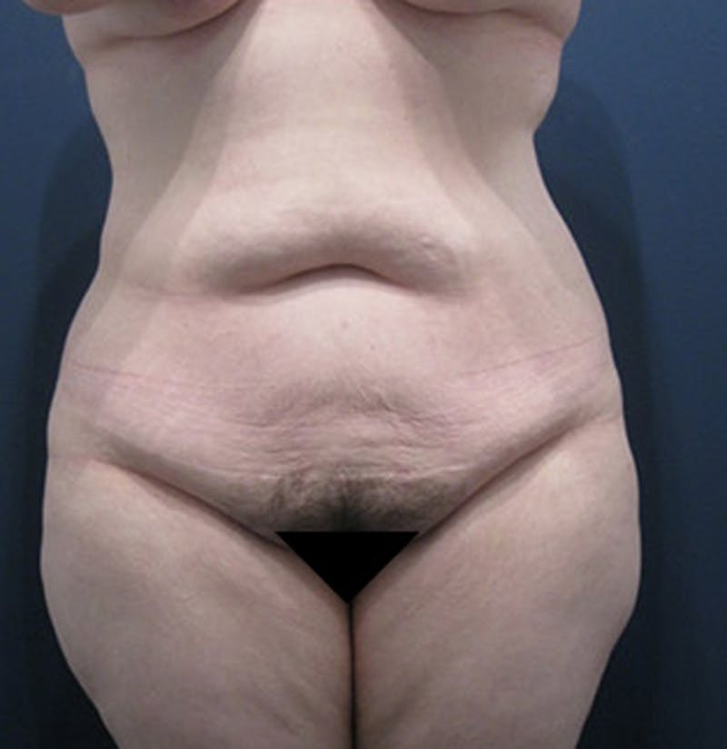 Tummy Tuck Before & After Gallery - Patient 174164508 - Image 1