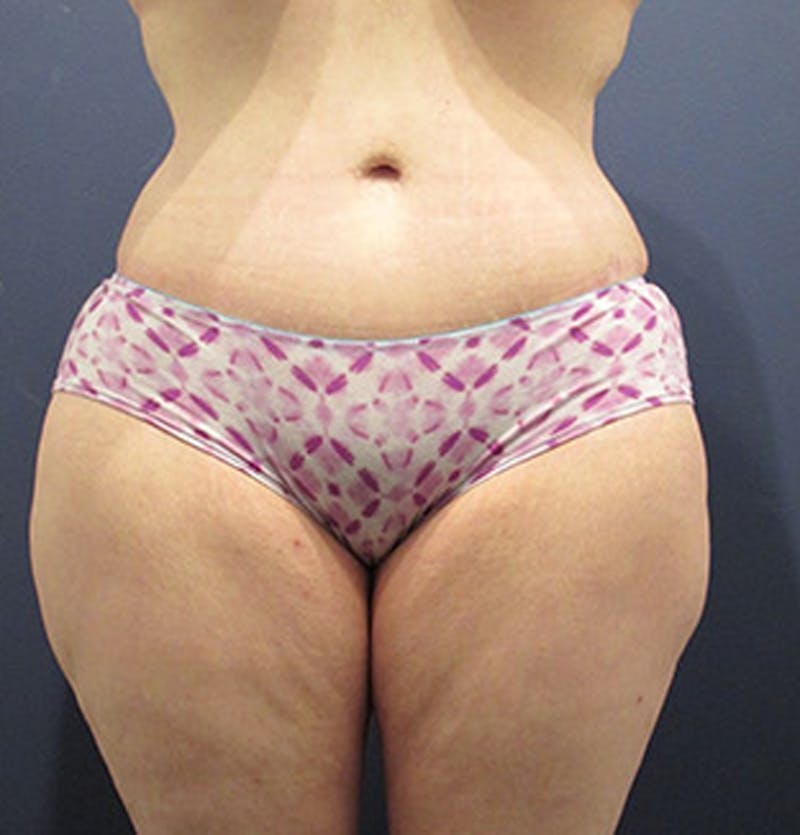 Tummy Tuck Before & After Gallery - Patient 174164508 - Image 2