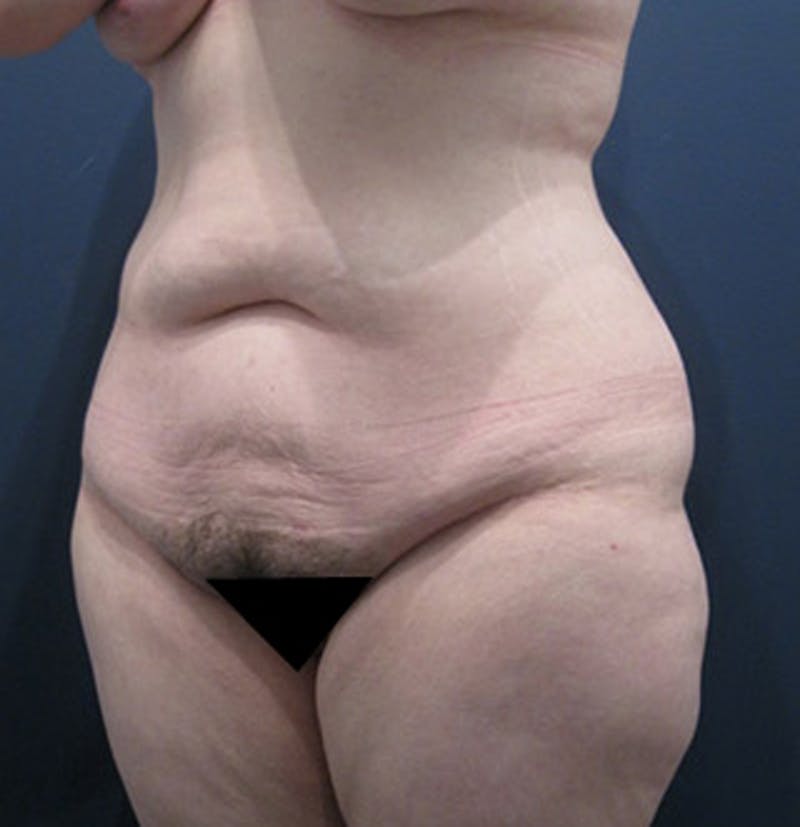 Tummy Tuck Before & After Gallery - Patient 174164508 - Image 3