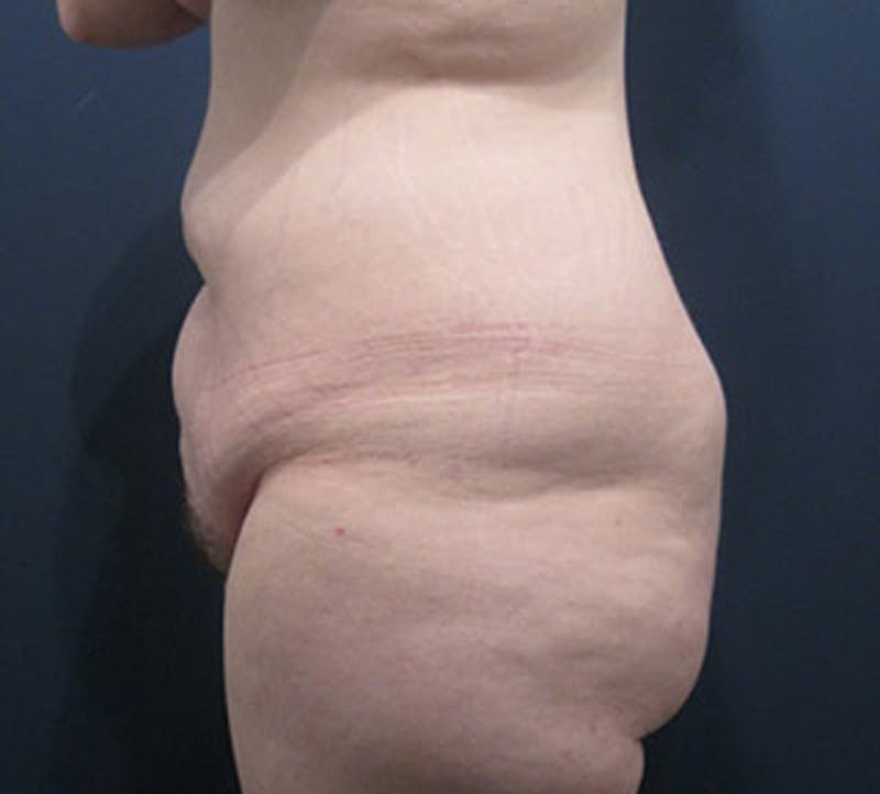 Tummy Tuck Before & After Gallery - Patient 174164508 - Image 5