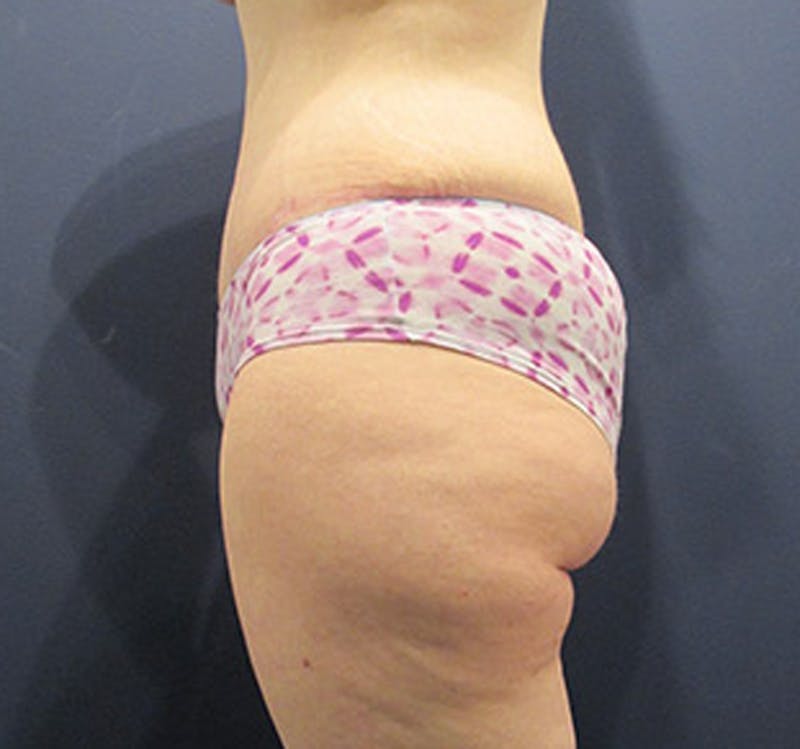 Tummy Tuck Before & After Gallery - Patient 174164508 - Image 6
