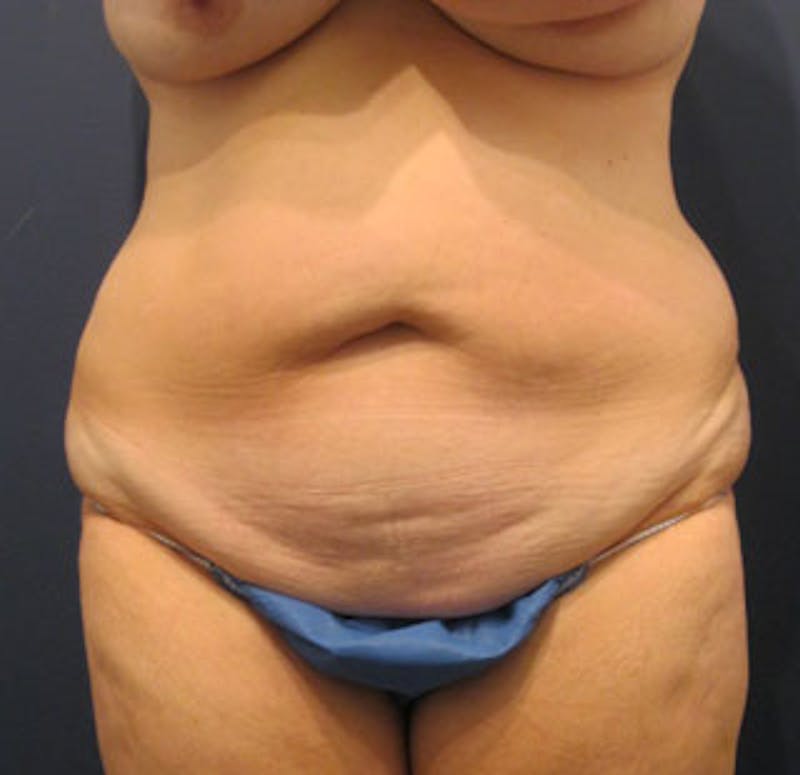 Tummy Tuck Before & After Gallery - Patient 174164510 - Image 1