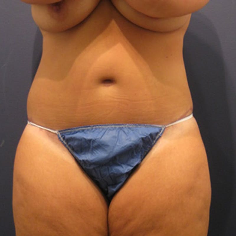 Tummy Tuck Before & After Gallery - Patient 174164510 - Image 2
