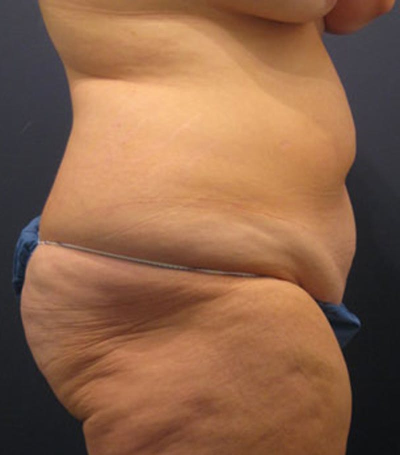 Tummy Tuck Before & After Gallery - Patient 174164510 - Image 5