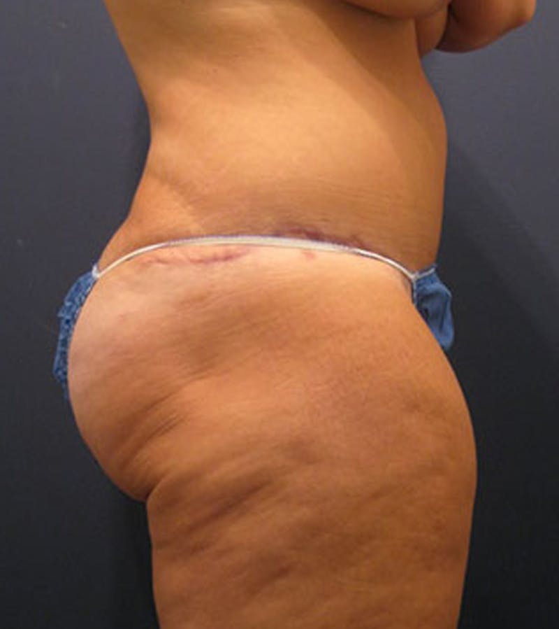 Tummy Tuck Before & After Gallery - Patient 174164510 - Image 6