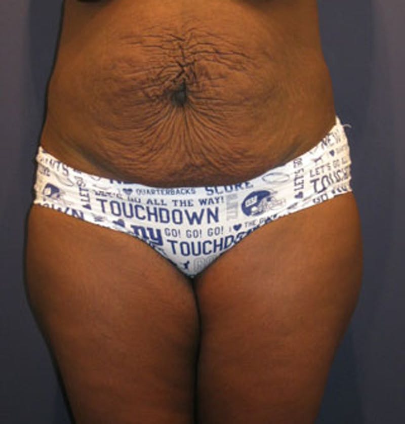 Tummy Tuck Before & After Gallery - Patient 174164512 - Image 1
