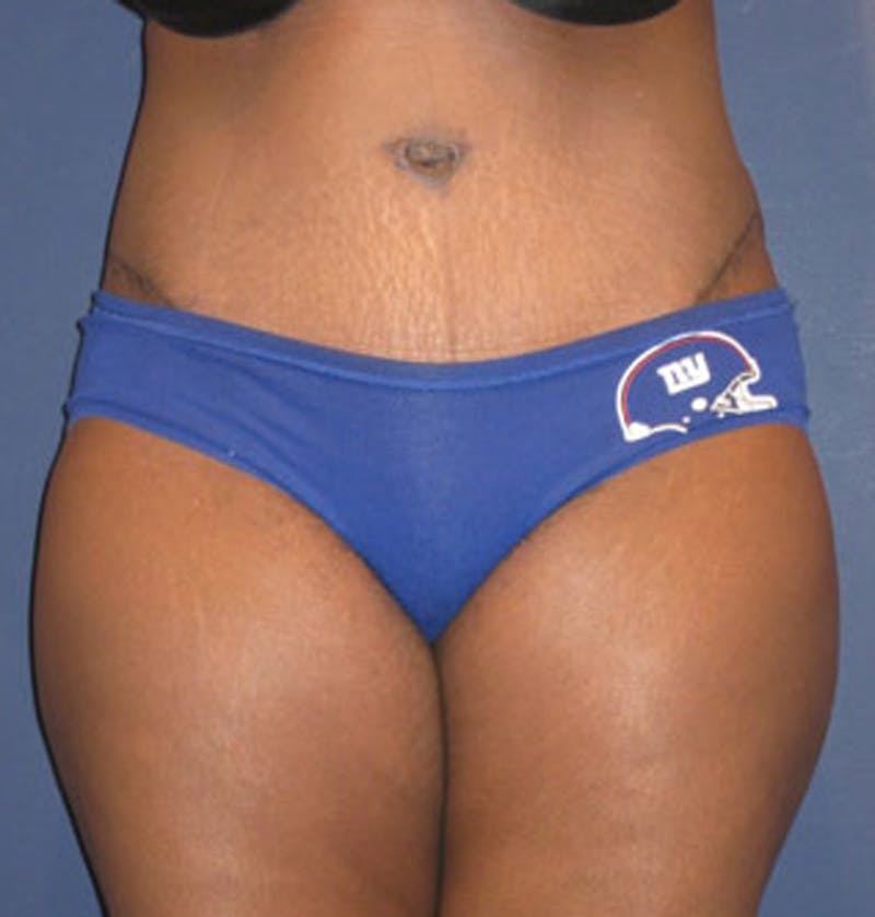 Tummy Tuck Before & After Gallery - Patient 174164512 - Image 2