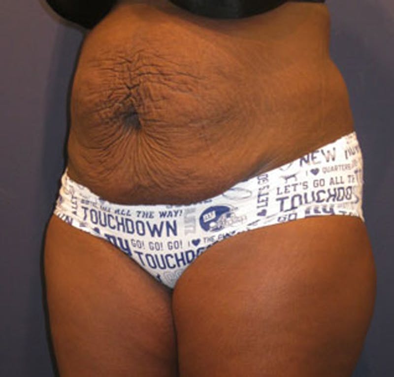 Tummy Tuck Before & After Gallery - Patient 174164512 - Image 3