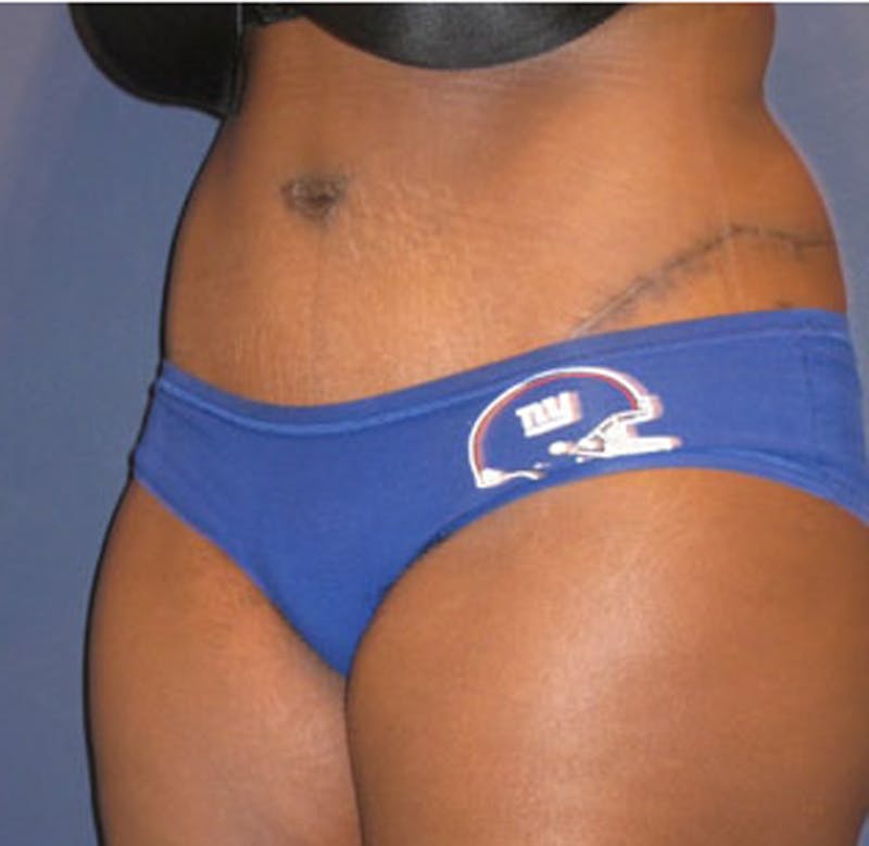 Tummy Tuck Before & After Gallery - Patient 174164512 - Image 4
