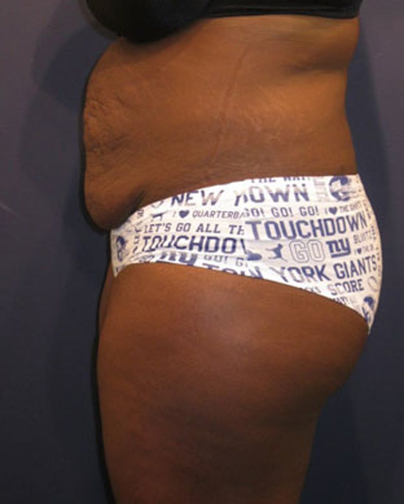 Tummy Tuck Before & After Gallery - Patient 174164512 - Image 5