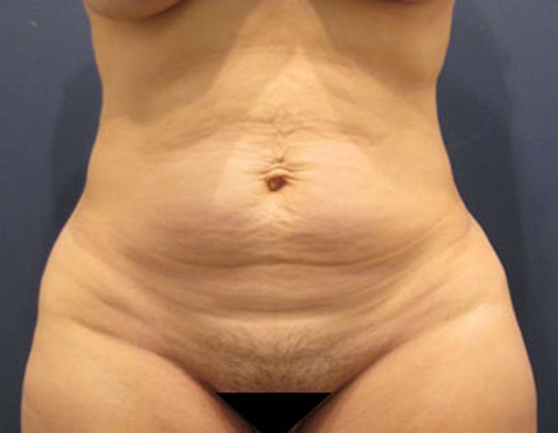 Tummy Tuck Before & After Gallery - Patient 174164515 - Image 1