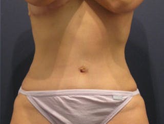 Tummy Tuck Before & After Gallery - Patient 174164515 - Image 2