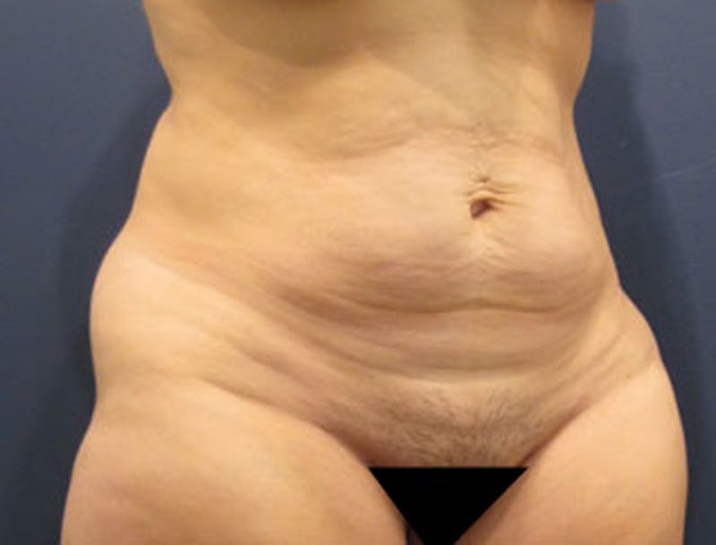 Tummy Tuck Before & After Gallery - Patient 174164515 - Image 3