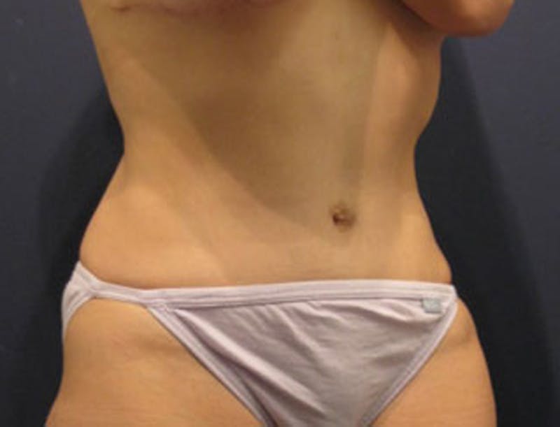 Tummy Tuck Before & After Gallery - Patient 174164515 - Image 4