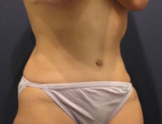 Tummy Tuck Before & After Gallery - Patient 174164515 - Image 4