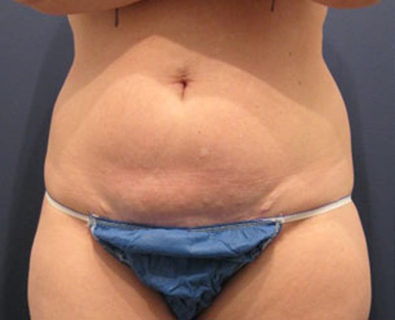 Tummy Tuck Before & After Gallery - Patient 174165588 - Image 1