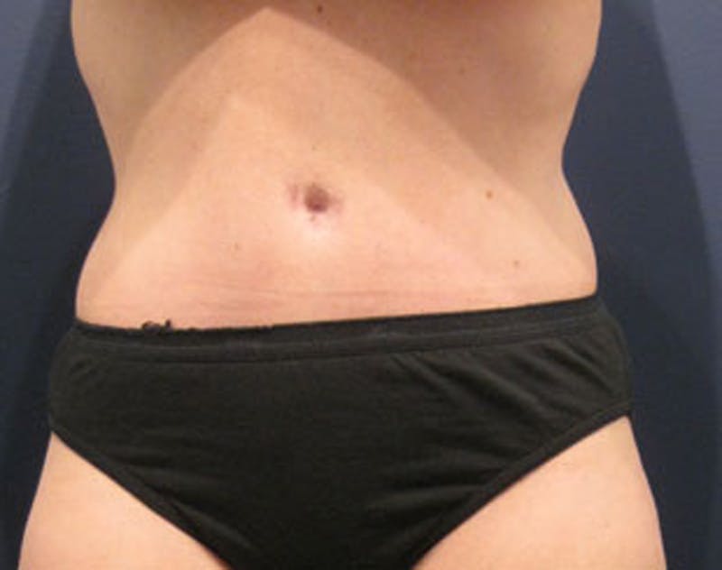 Tummy Tuck Before & After Gallery - Patient 174165588 - Image 2