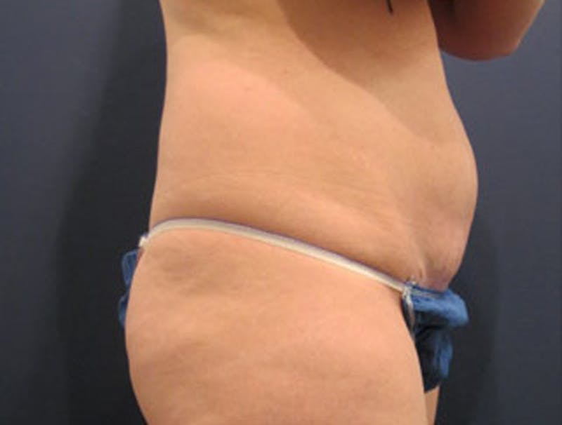 Tummy Tuck Before & After Gallery - Patient 174165588 - Image 3