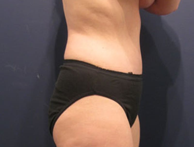 Tummy Tuck Before & After Gallery - Patient 174165588 - Image 4