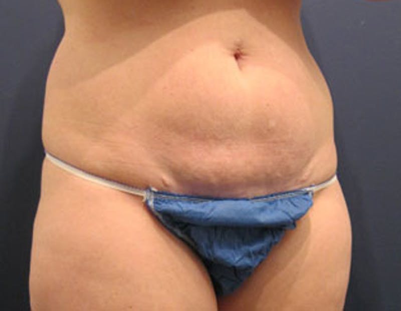 Tummy Tuck Before & After Gallery - Patient 174165588 - Image 5