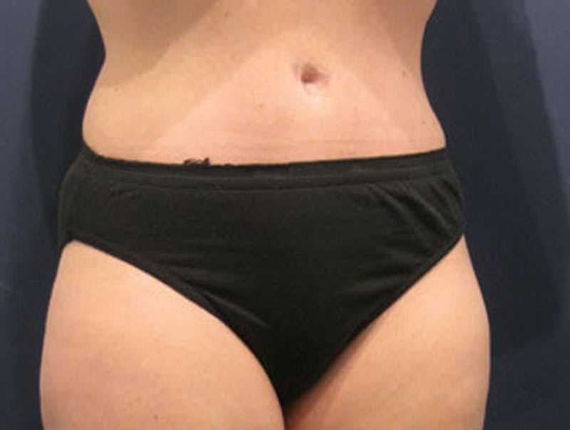 Tummy Tuck Before & After Gallery - Patient 174165588 - Image 6