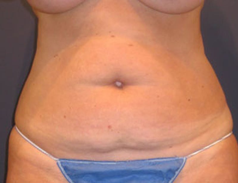 Tummy Tuck Before & After Gallery - Patient 174165589 - Image 1