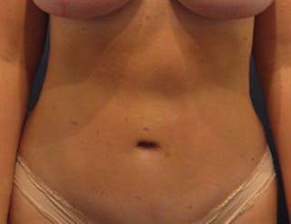 Tummy Tuck Before & After Gallery - Patient 174165589 - Image 2