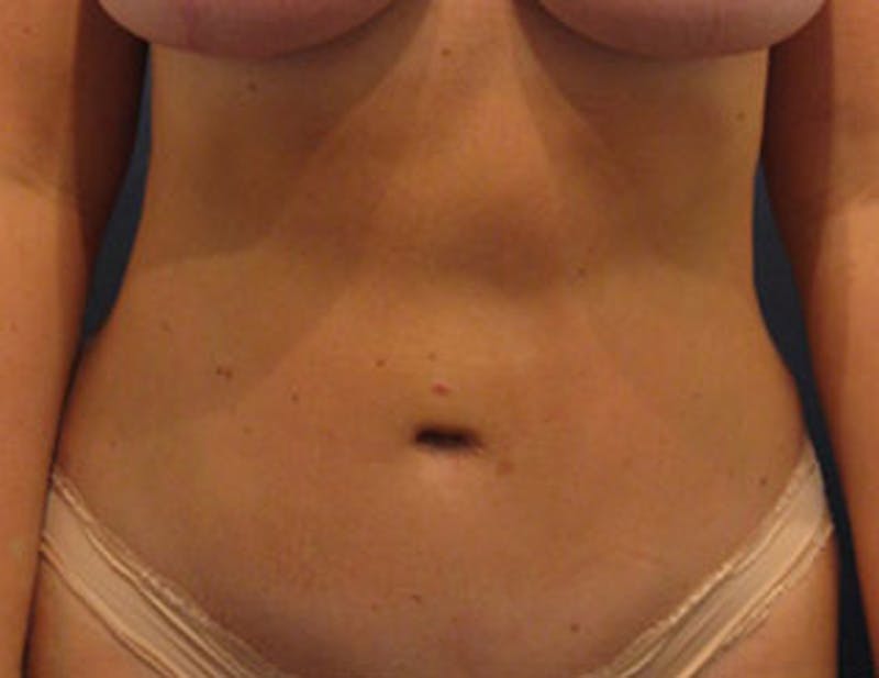Tummy Tuck Before & After Gallery - Patient 174165589 - Image 2