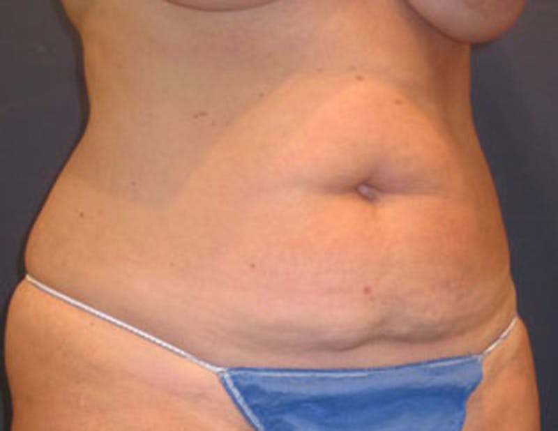 Tummy Tuck Before & After Gallery - Patient 174165589 - Image 3