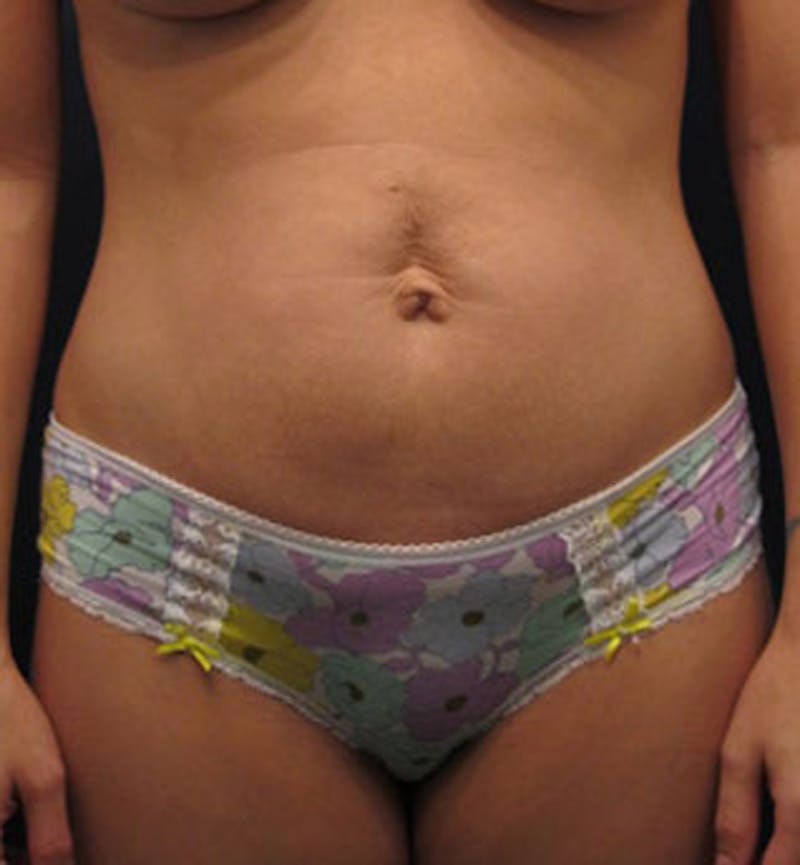 Tummy Tuck Before & After Gallery - Patient 174165590 - Image 1
