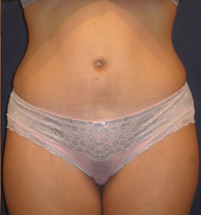 Tummy Tuck Before & After Gallery - Patient 174165590 - Image 2