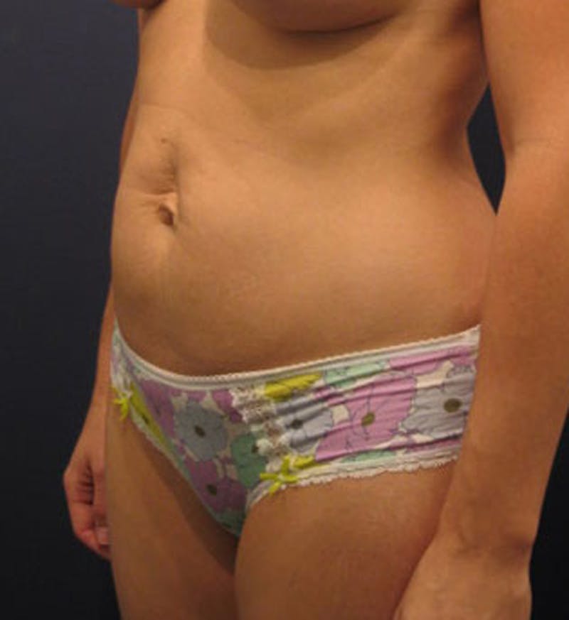 Tummy Tuck Before & After Gallery - Patient 174165590 - Image 3