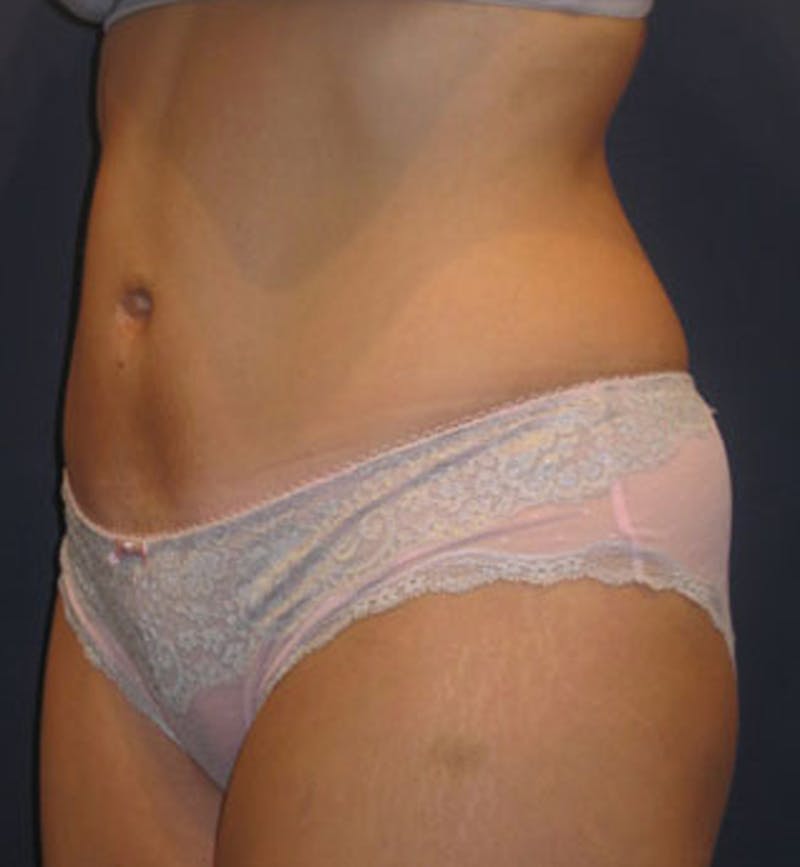 Tummy Tuck Before & After Gallery - Patient 174165590 - Image 4