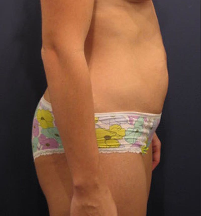 Tummy Tuck Before & After Gallery - Patient 174165590 - Image 5