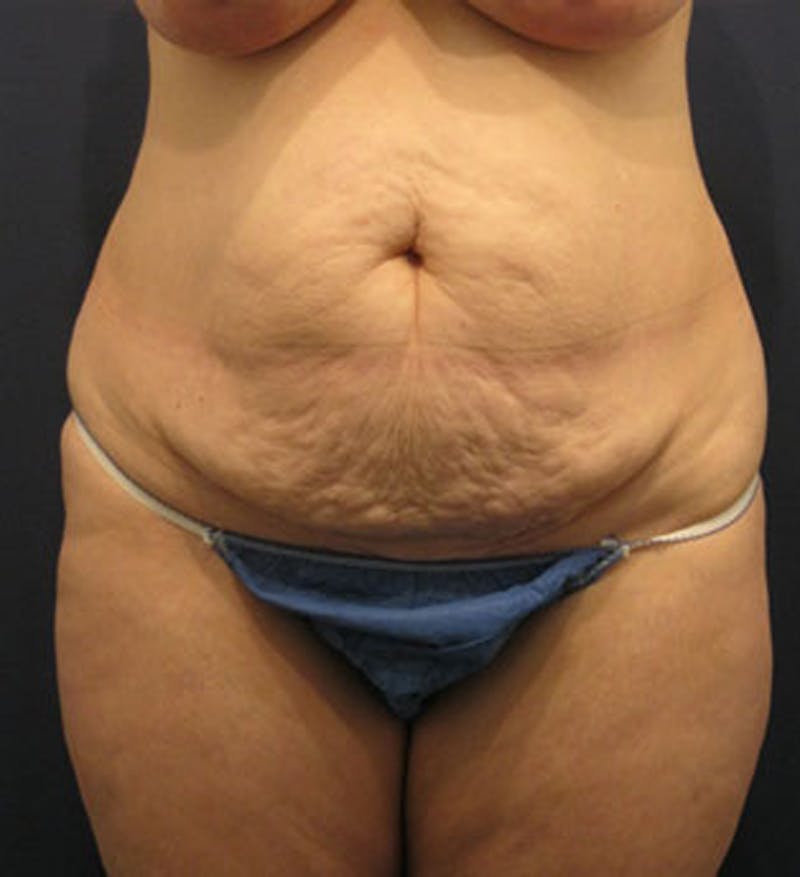 Tummy Tuck Before & After Gallery - Patient 174166663 - Image 1