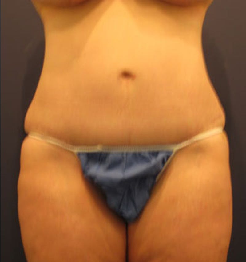 Tummy Tuck Before & After Gallery - Patient 174166663 - Image 2