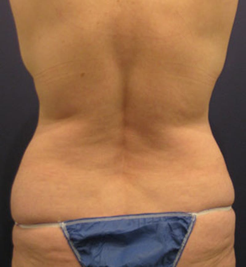 Tummy Tuck Before & After Gallery - Patient 174166663 - Image 3