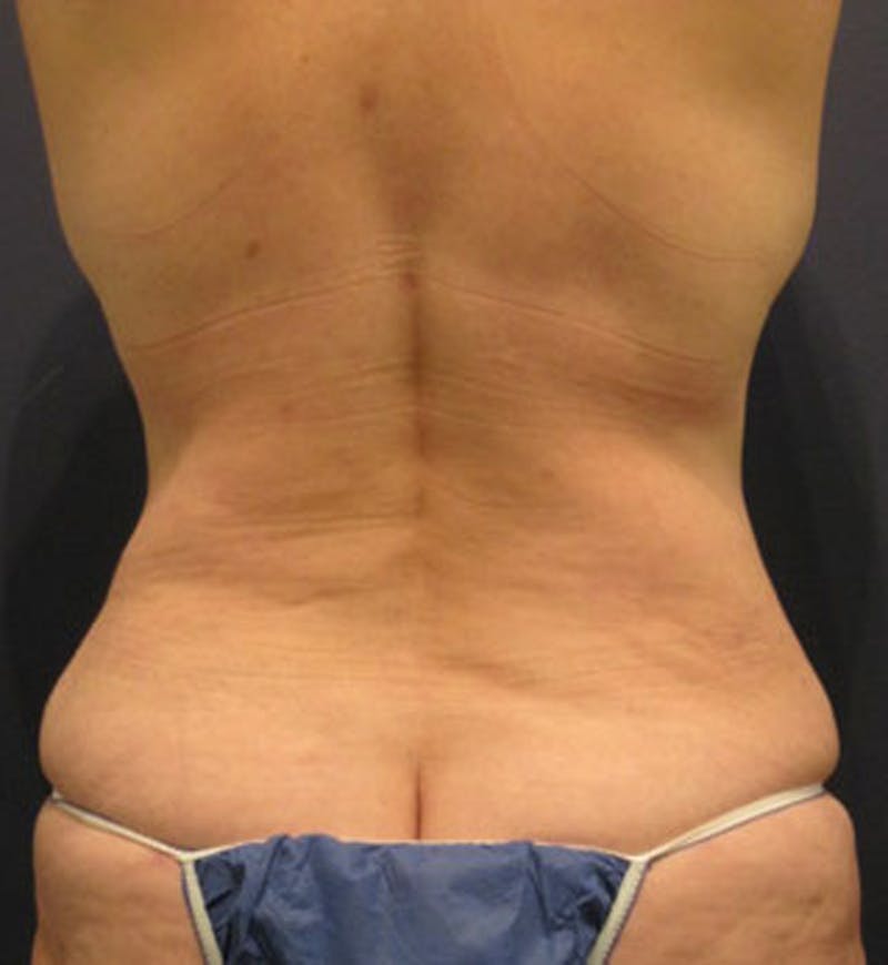 Tummy Tuck Before & After Gallery - Patient 174166663 - Image 4