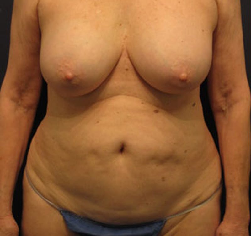 Tummy Tuck Before & After Gallery - Patient 174166665 - Image 1
