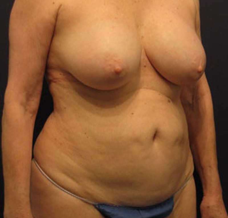 Tummy Tuck Before & After Gallery - Patient 174166665 - Image 3