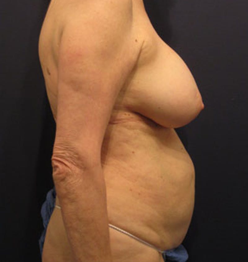 Tummy Tuck Before & After Gallery - Patient 174166665 - Image 5