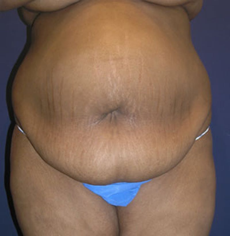 Tummy Tuck Before & After Gallery - Patient 174166671 - Image 1