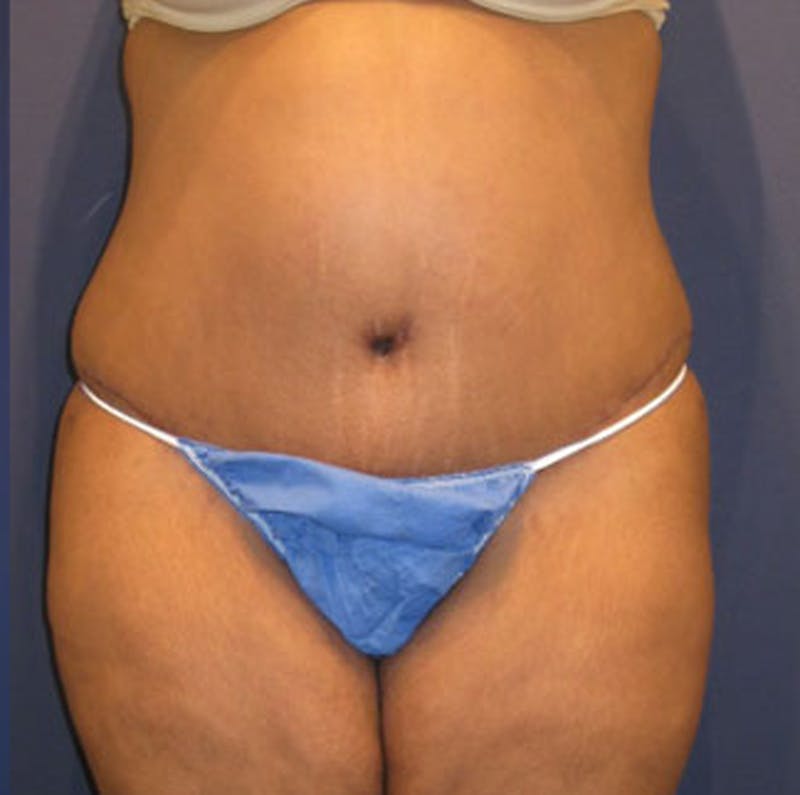 Tummy Tuck Before & After Gallery - Patient 174166671 - Image 2