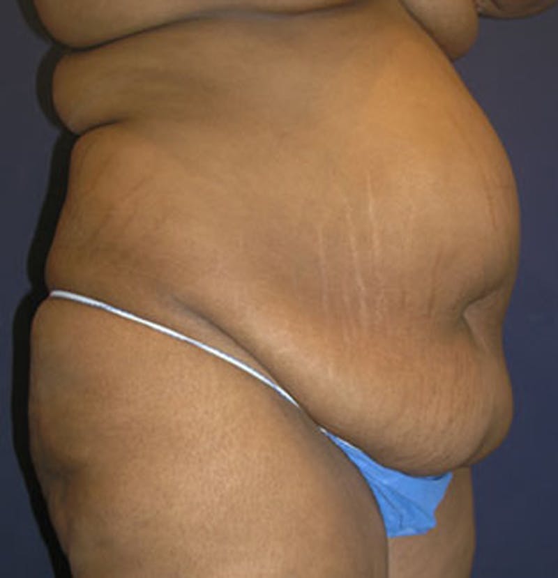 Tummy Tuck Before & After Gallery - Patient 174166671 - Image 3