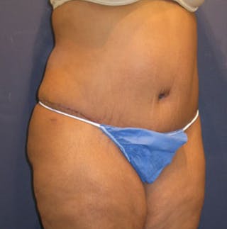 Tummy Tuck Before & After Gallery - Patient 174166671 - Image 4