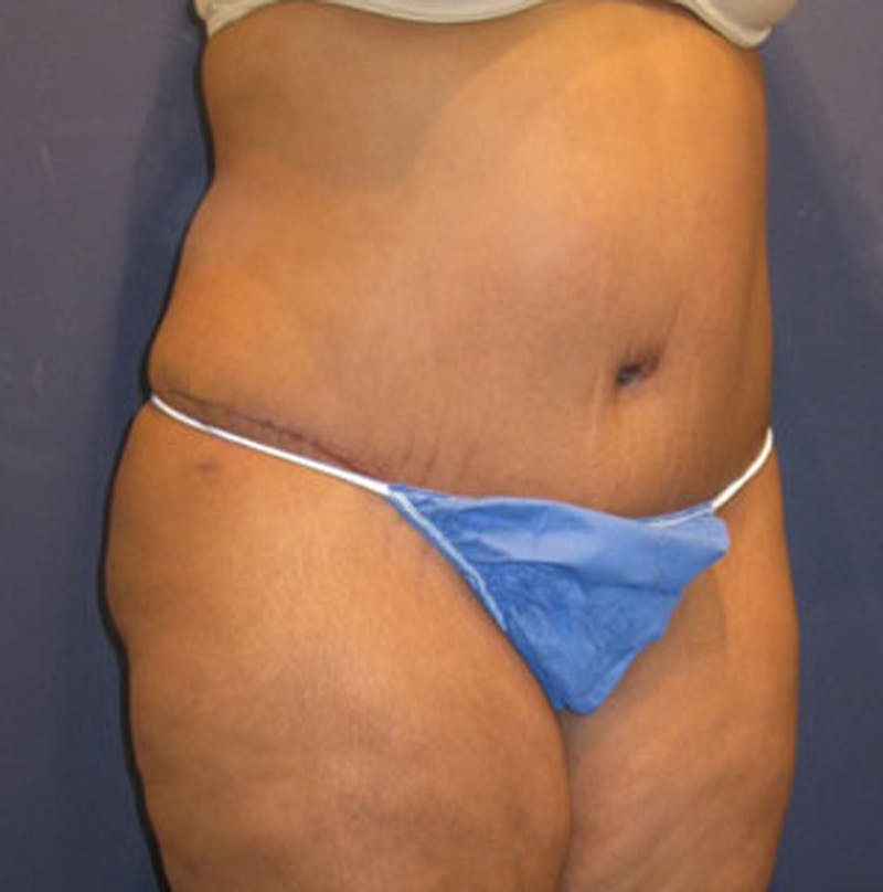 Tummy Tuck Before & After Gallery - Patient 174166671 - Image 4