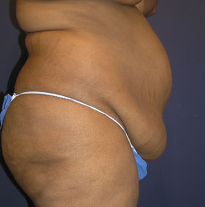 Tummy Tuck Before & After Gallery - Patient 174166671 - Image 5