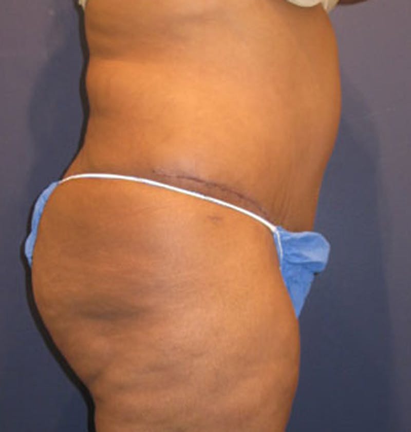 Tummy Tuck Before & After Gallery - Patient 174166671 - Image 6