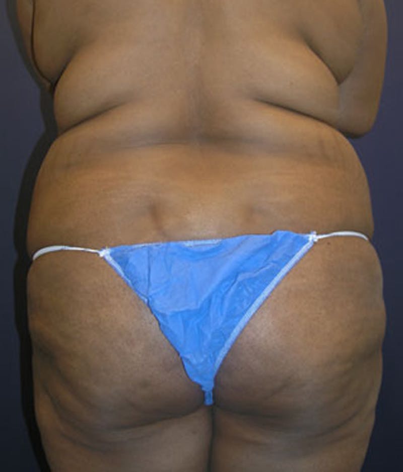 Tummy Tuck Before & After Gallery - Patient 174166671 - Image 7