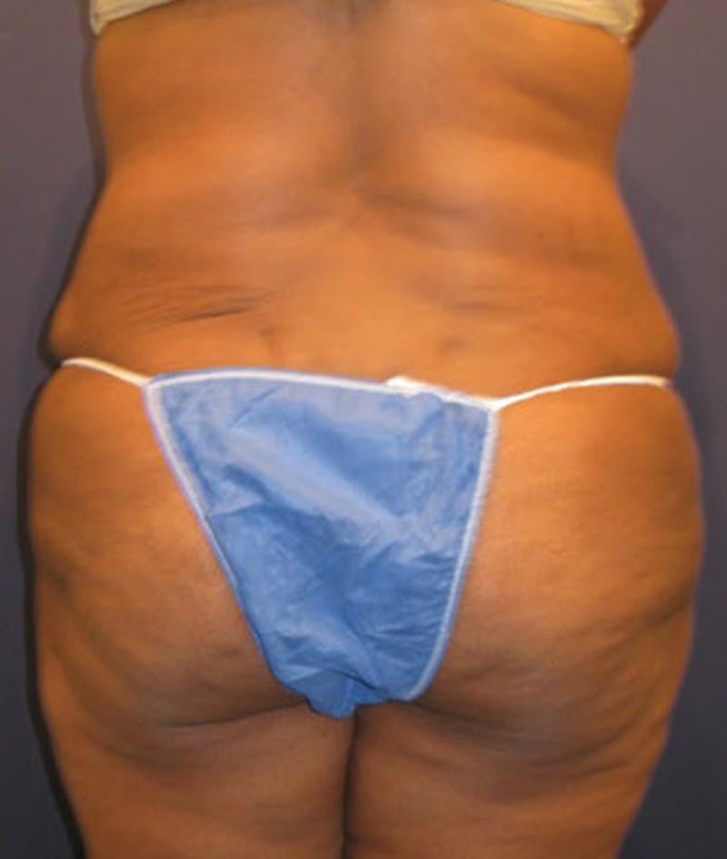 Tummy Tuck Before & After Gallery - Patient 174166671 - Image 8